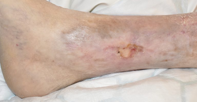 Ulceras en la pierna