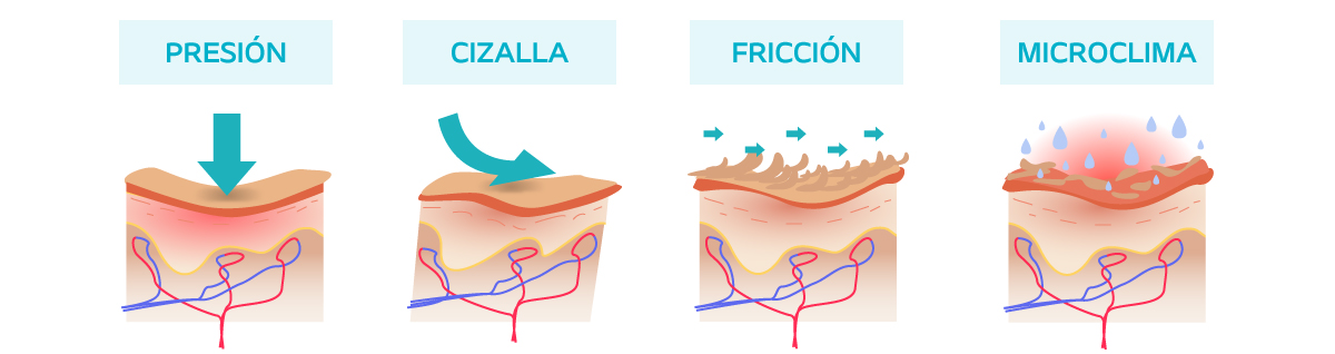 úlceras por presión