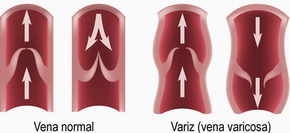 terapia compresiva