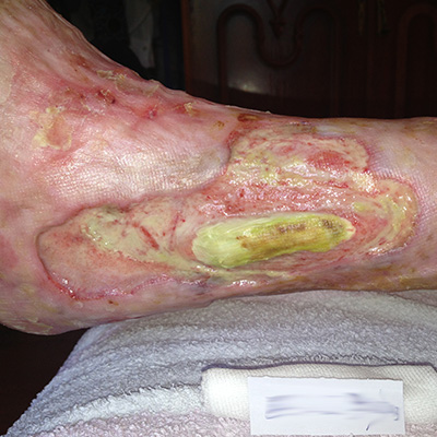 Amedrentador Adulto solapa Cicatrización de heridas: ¿qué hacemos cuando las úlceras en las piernas no  cicatrizan?