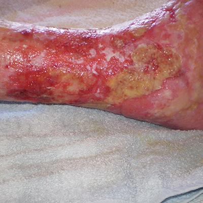 Cicatrización de heridas: ¿qué hacemos cuando las úlceras ...