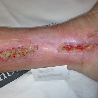 Heridas que no cicatrizan: síntomas de la EAP