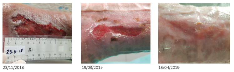 2019-10-01 18_08_55-CASO CLINICO Silvia Blasco. Biatain Silicone Ag y Biatain Silicone.pdf
