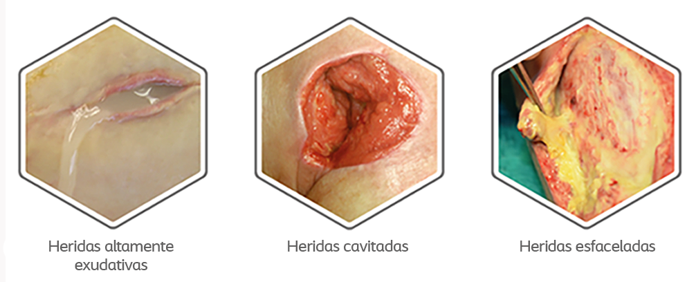 tipos heridas indicado aposito de fibra gelificante